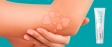 Eczema: its features and treatment