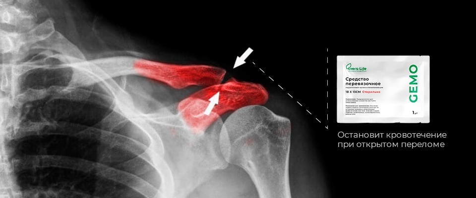 Open fracture: features of this injury, how to provide first aid