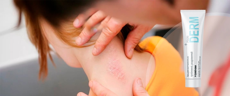 Psoriasis: what are the causes of the exacerbation of the disease in the fall, what medications are used for its relief