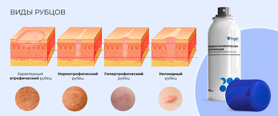 Means to prevent the formation of scars: types of drugs and their benefits